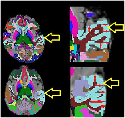 Structural Magnetic Resonance Imaging Demonstrates Abnormal Regionally-Differential Cortical Thickness Variability in Autism: From Newborns to Adults